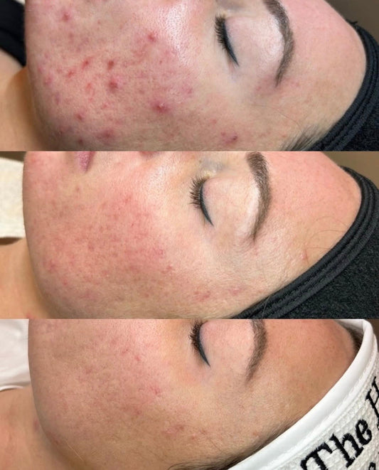 I Googled 'Acne Treatment Miami' — Here's What Finally Worked