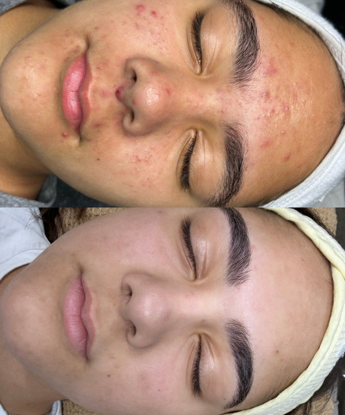 Acne Treatment Miami: Why Laser & Professional Skincare Beat Everything Else