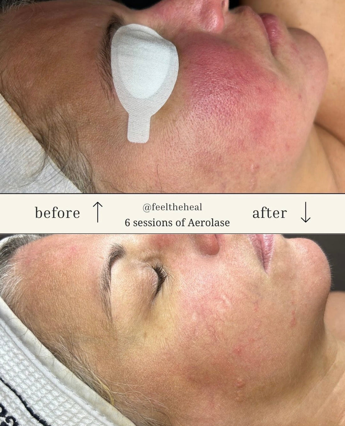 I Googled 'Aerolase Laser Miami' — Here's My Honest Experience