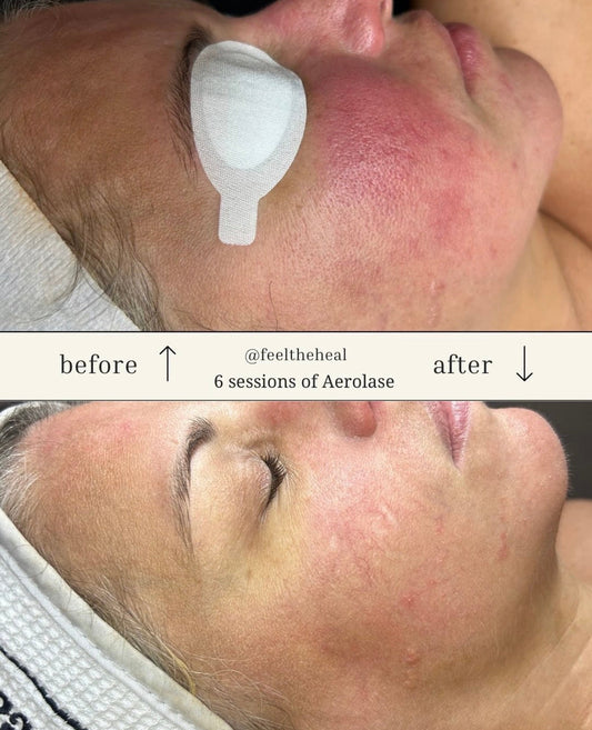 I Googled 'Aerolase Laser Miami' — Here's My Honest Experience