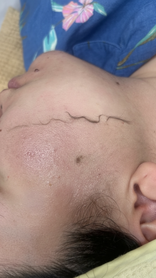 dermaplaning Miami