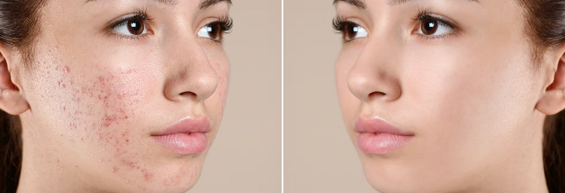 Why Your Skin Won't Clear Up Until You Fix Your Gut