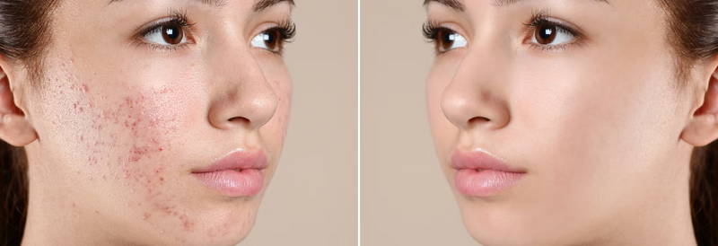 Why Your Skin Won't Clear Up Until You Fix Your Gut