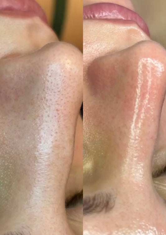 HydraFacial Miami: The Ultimate Skin Reset for Every Skin Type