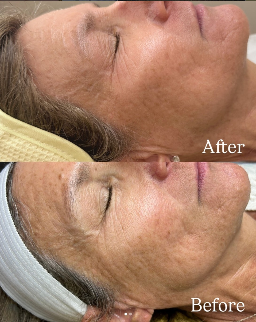 I Googled 'Microneedling Miami' — Here's What I Found and Why I Chose PRP