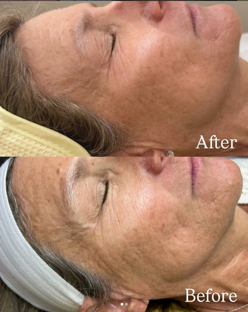 I Googled 'Microneedling Miami' — Here's What I Found and Why I Chose PRP