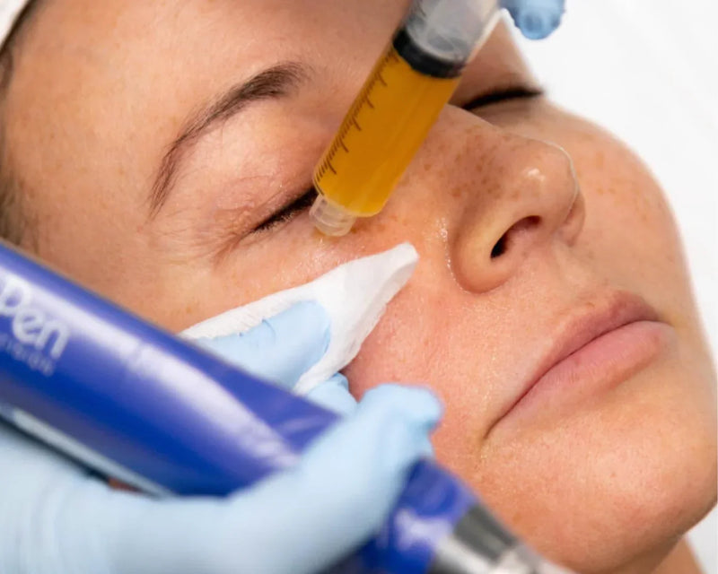 PDRN vs. PRP vs. Exosomes Microneedling Miami