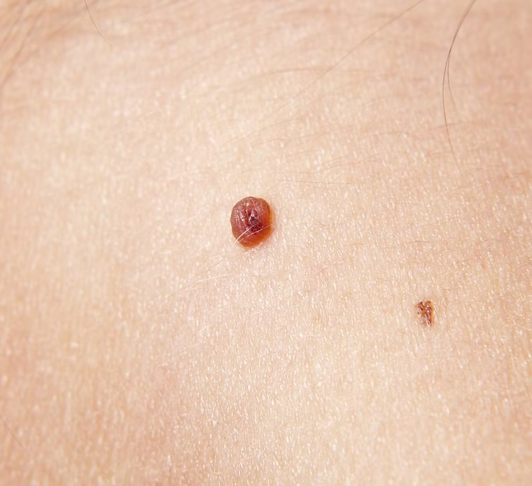Close-up of a skin lesion on human skin