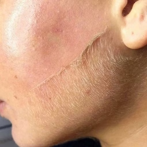 Dermaplaning miami feel the heal