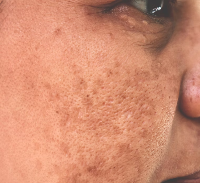 Close-up of a person's skin with visible pores and texture