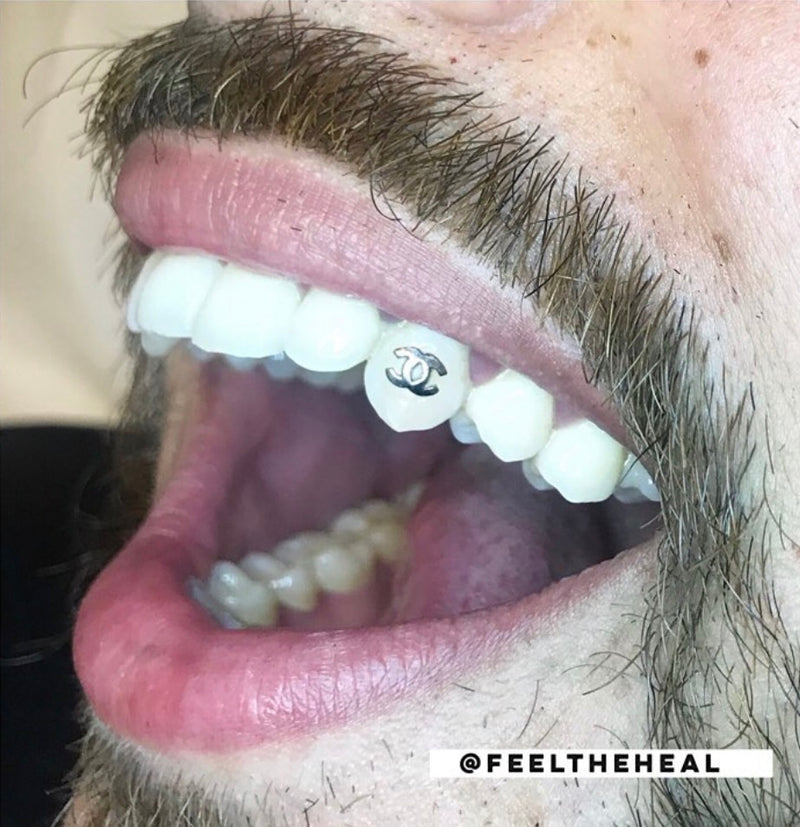 Close-up of a person's mouth with a visible dental issue and white aligners.