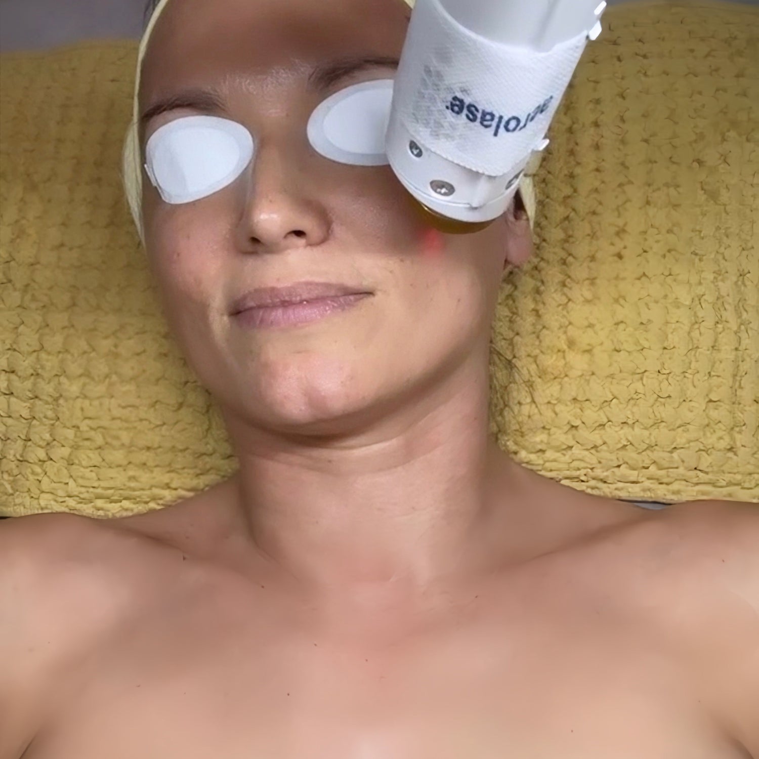 Woman receiving laser treatment on her face with a laser device held above her.