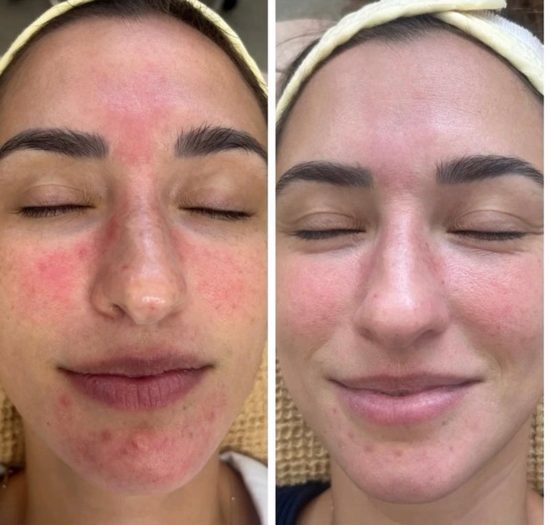 before and after aerolase neo miami feel the heal 