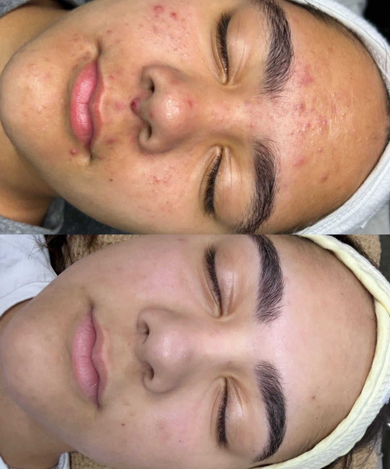 before and after acne treatment