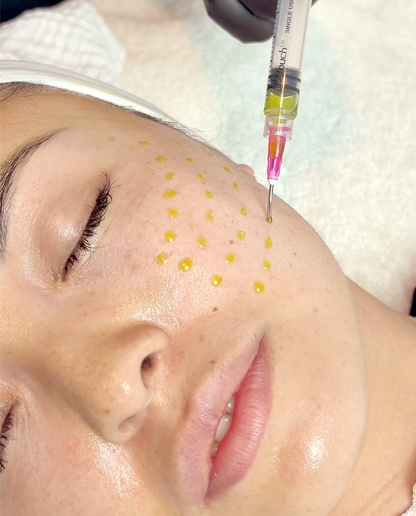 Close-up of a person receiving facial injection treatment with visible markings on the face.