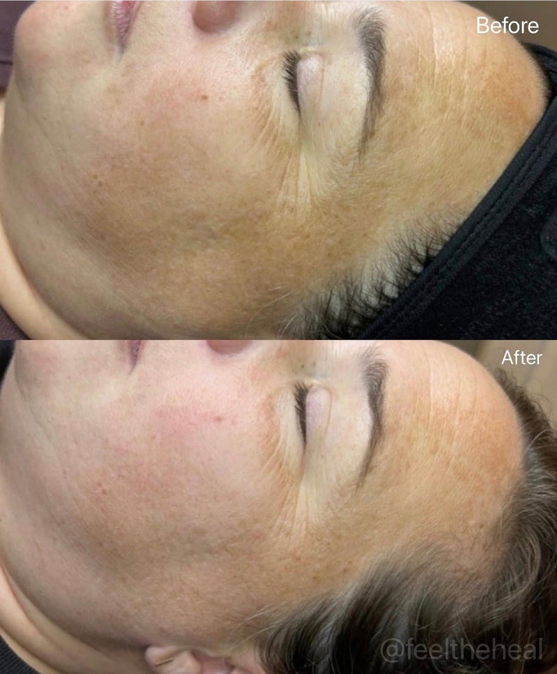 Before and after comparison of a person's neck area with visible skin texture differences.