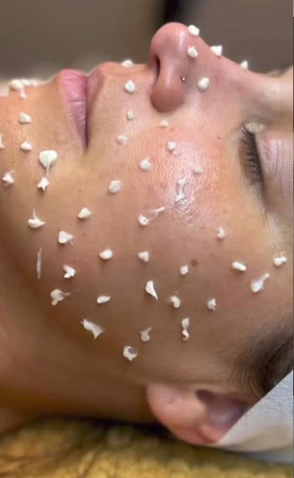 Close-up of a person's face with small white objects on the skin