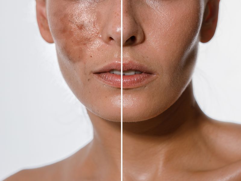Before and after comparison of a woman's face with visible skin texture and blemishes on the left, and smoother skin on the right.