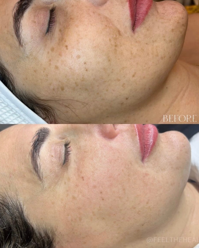 Before and after comparison of a person's face with visible skin texture changes.