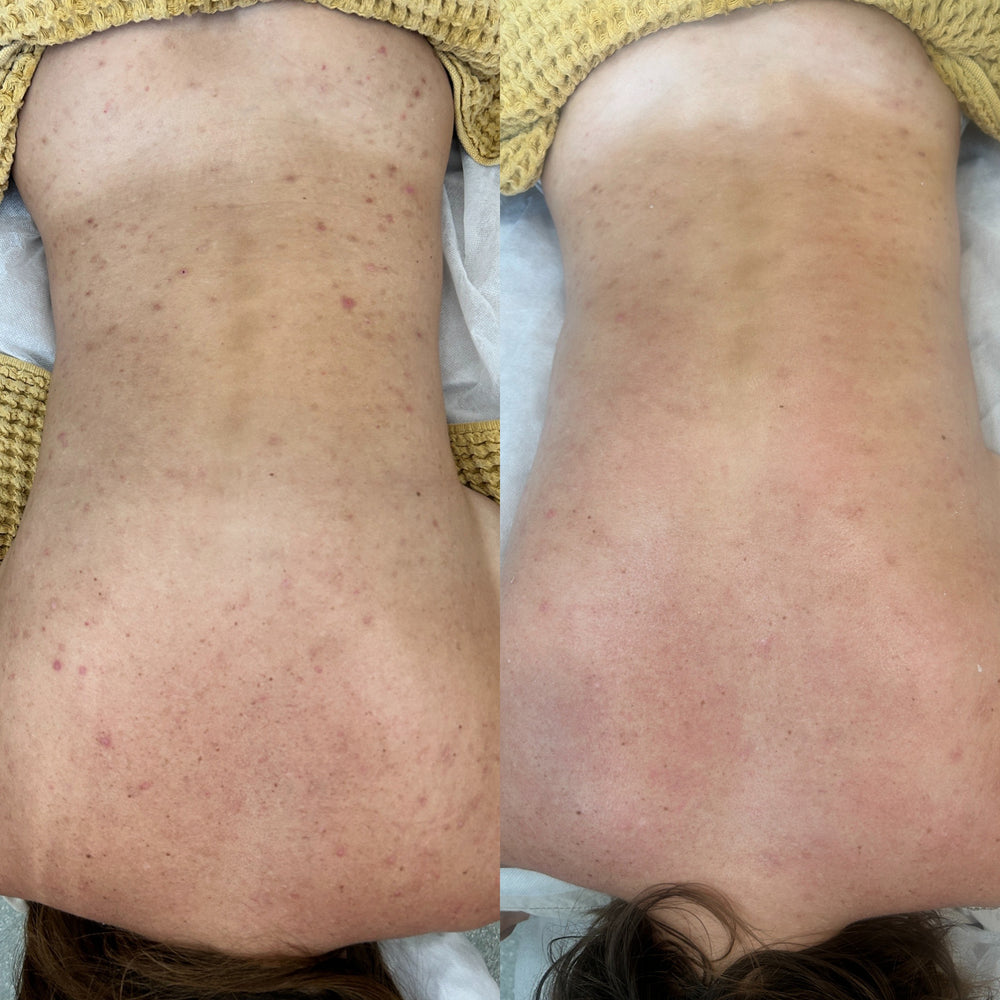 Before and after comparison of a person's knee area with visible skin texture and blemishes.