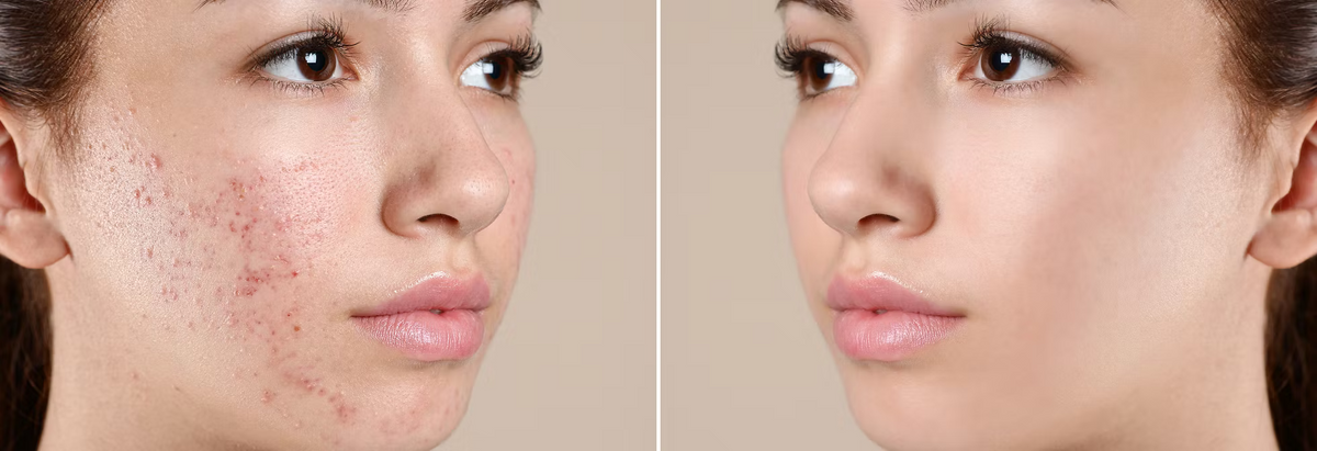 face reality acne program at feel the heal