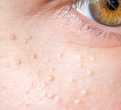 Close-up of a person's eye with visible skin texture.