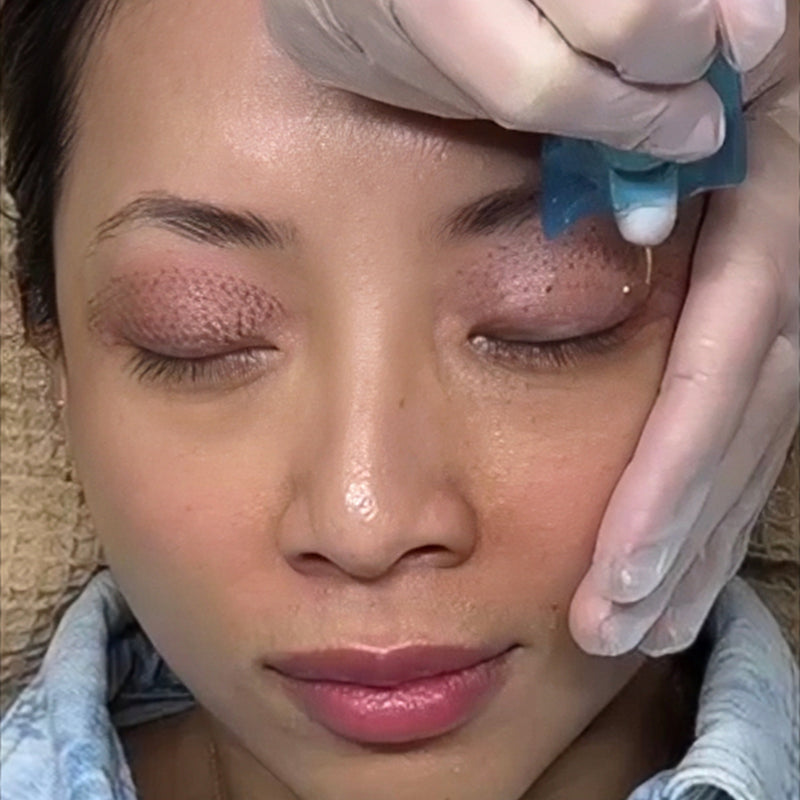 plasma fibroblast miami at feel the heal