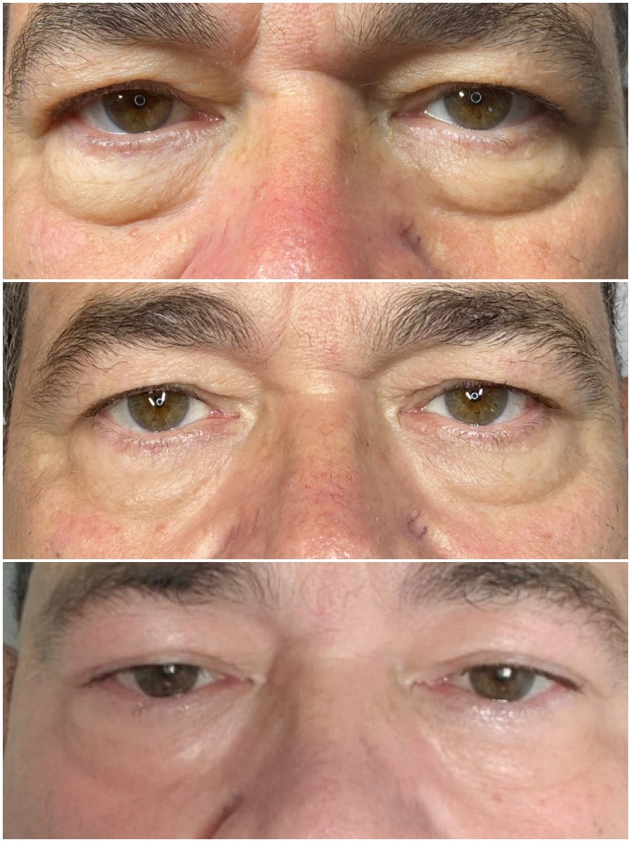 Three images showing a close-up of a person's eyes with a focus on the area around the eyes.