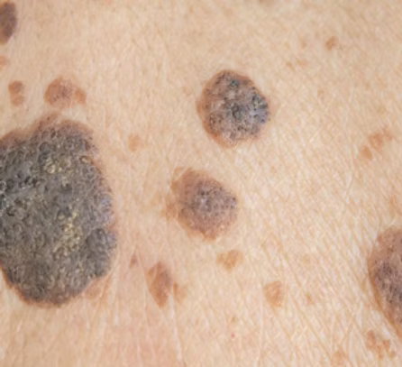 Close-up of skin with moles and uneven texture