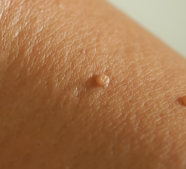 Close-up of a skin surface with a small mole.